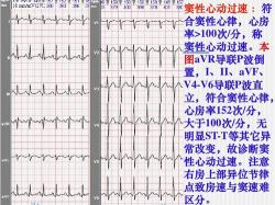 心率110左右意味着什么：解读心动过速的原因与应对方法