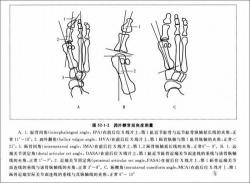 拇外翻咋治：从诊断到手术的全面治疗方法