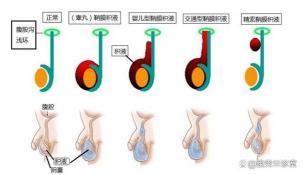 睾丸下垂：原因、影响与应对措施