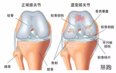 滑囊炎的症状、类型及治疗：全面解析