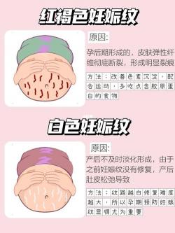 妊娠纹：女性的生理变化与应对之策