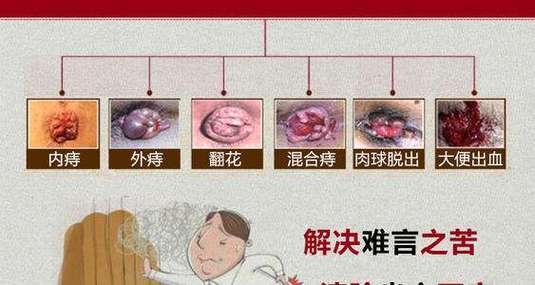 痔疮的症状：便血、疼痛和脱出，不同类型有不同表现