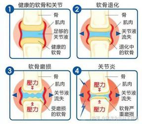 关节炎成因揭秘：从生活习惯到体重因素，了解关节炎的多元诱因及症状