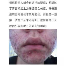 嘴角长痘的原因与应对策略：如何解决这一常见皮肤问题？