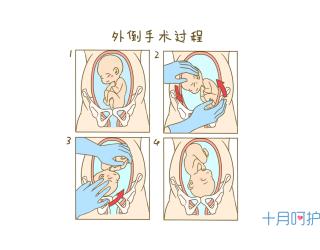 自然分娩：从预产期预测到胎位纠正的全面指南