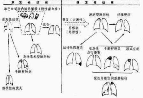 结核病症状：从无症状到严重症状的全面解析