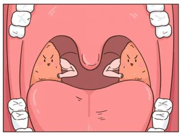 扁桃体切除：何时该考虑？了解手术背后的利弊得失