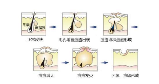 怎么除去痘痕？一文带你了解痘痕的形成、分类与有效治疗方法