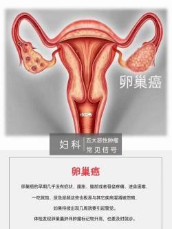 卵巢癌晚期症状全解析：腹痛、消瘦、压迫与转移，如何应对？