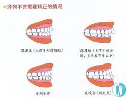 牙颌畸形：原因、症状及矫正方法详解