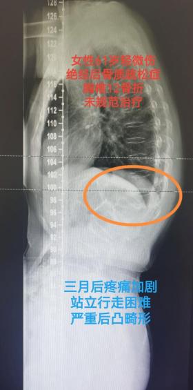 骨裂症状全解析：疼痛、肿胀、畸形与全身症状