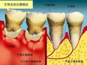 牙龈出血原因解析：从常见疾病到生活习惯的全面探讨