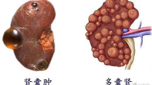 肾部囊肿解析：原因、症状及应对策略