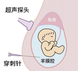 羊水穿刺怎么做：详细步骤与注意事项