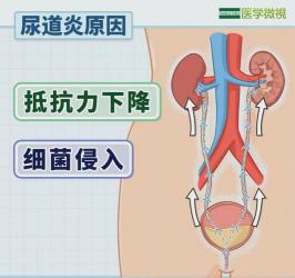 尿急尿痛：女性尿路感染的信号与应对策略