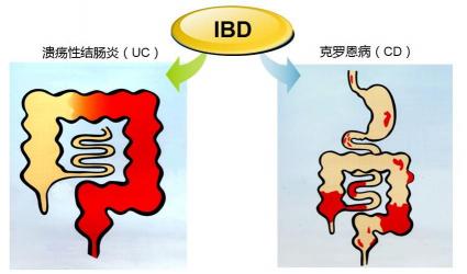 肠胃炎的症状有哪些？一文带你全面了解