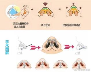 自体软骨隆鼻手术详解：步骤与优势