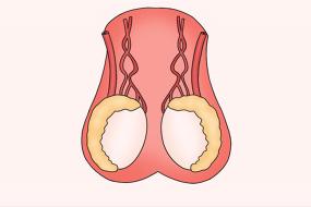 睾丸附睾炎的症状及治疗方法