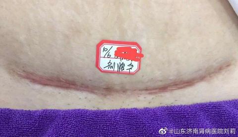 剖腹产疤痕修复：预防与治疗方法全面解析