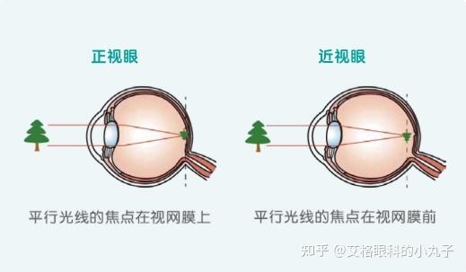 真视之眼：近视眼的特征、成因与影响