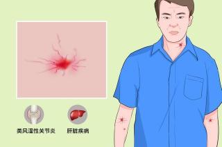 肝硬化：肝病大国面临的重要疾病