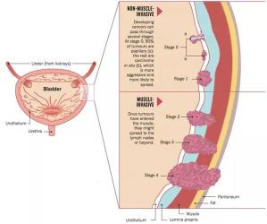 膀胱癌能活多久？及时治疗与生存期的重要关联