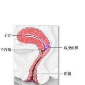 揭秘子宫颈肉瘤：致病因素与应对策略