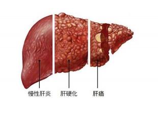 肝炎的五大早期症状：及时发现及时治疗