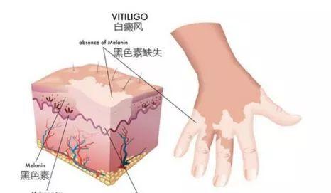 白癜风的发病原因：精神神经因素、自身免疫、黑色素细胞自毁等多因素影响