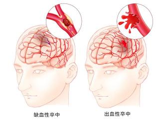 脑蛛网膜下腔出血：严重病症的症状、原因及应对方法