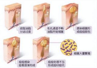 痘痘挤出来的是什么：皮脂分泌物、脓性分泌物还是脂肪酸？