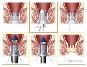 微创治疗痔疮：过程、可能的后遗症及护理