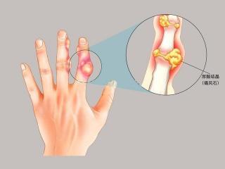 痛风病的症状及不同阶段的应对策略