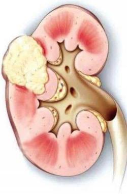 肾肿瘤的症状：疼痛、血尿、腹部包块及发热需警惕