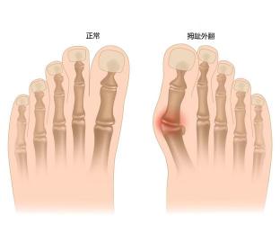 脚大拇指麻：原因与缓解方法