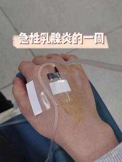 急性乳腺炎的症状及处理方法