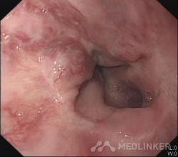 吐血的原因：急性胃肠炎、胃及十二指肠疾病、食管或胃底静脉曲张破裂等