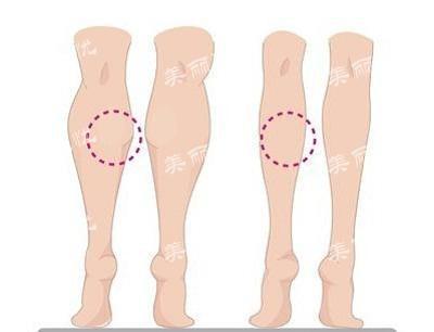 不同类型小腿的瘦腿方法：肌肉型、松弛型、浮肿型