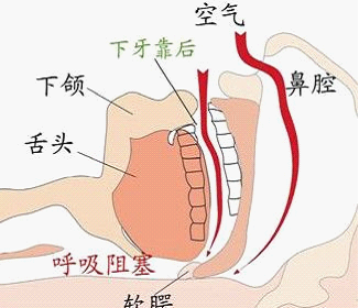 打呼噜的原因及解决方法：改善睡眠质量的关键